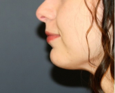 Feel Beautiful - Neck Liposuction 202 - After Photo